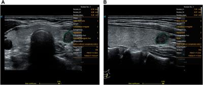 S-Thyroid Computer-Aided Diagnosis Ultrasound System of Thyroid Nodules: Correlation Between Transverse and Longitudinal Planes